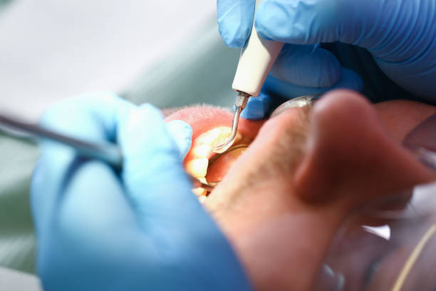 Best Emergency Tooth Extraction in Harbison Nyon, CA
